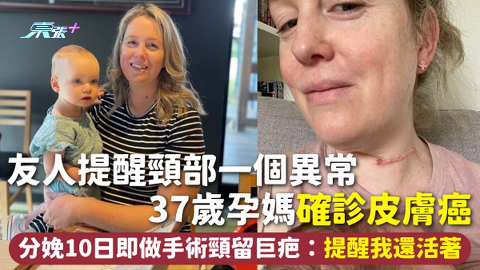 皮膚癌 | 友人提醒頸部一個異常 37歲孕媽確診皮膚癌 分娩10日即做手術頸留巨疤：提醒我還活著