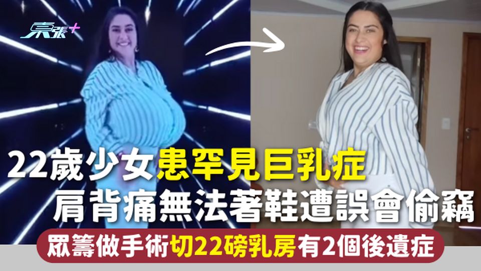 罕見病 | 22歲少女患巨乳症 肩背痛無法著鞋遭誤會偷竊 眾籌做手術切22磅乳房 有2個後遺症
