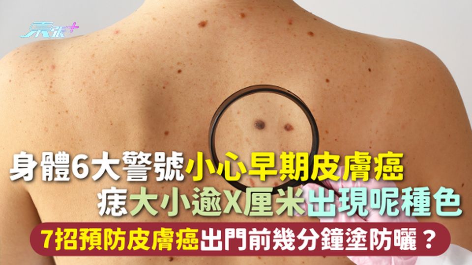 皮膚癌 | 身體6大警號小心早期皮膚癌 痣大小逾X厘米出現呢種色 7招預防皮膚癌出門前幾分鐘塗防曬？