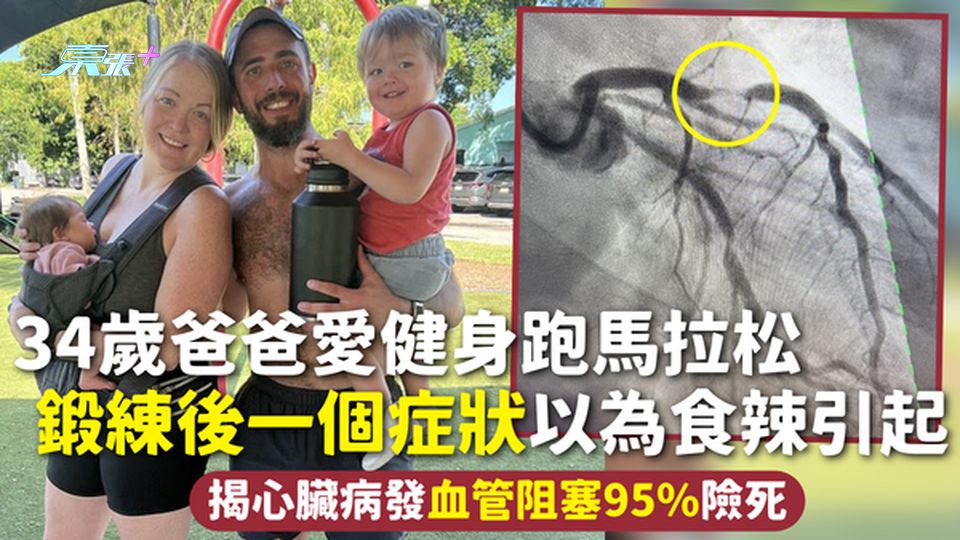 心臟病 | 34歲爸爸愛健身跑馬拉松 鍛練後一個症狀以為食辣引起 揭血管阻塞95%險死