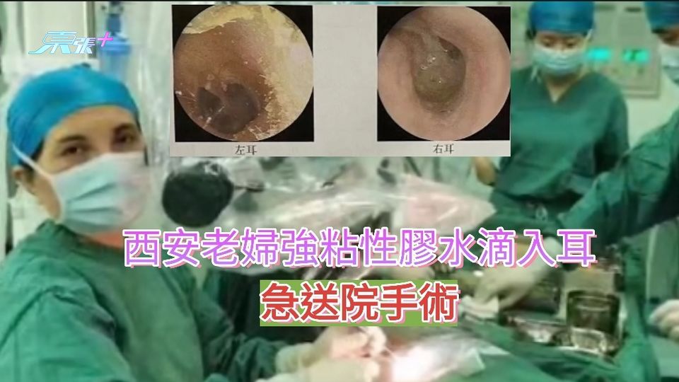 西安老婦強粘性膠水滴入耳孔，急送院手術
