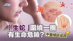 「生蛇」圍繞一圈有生命危險？中醫細談成因