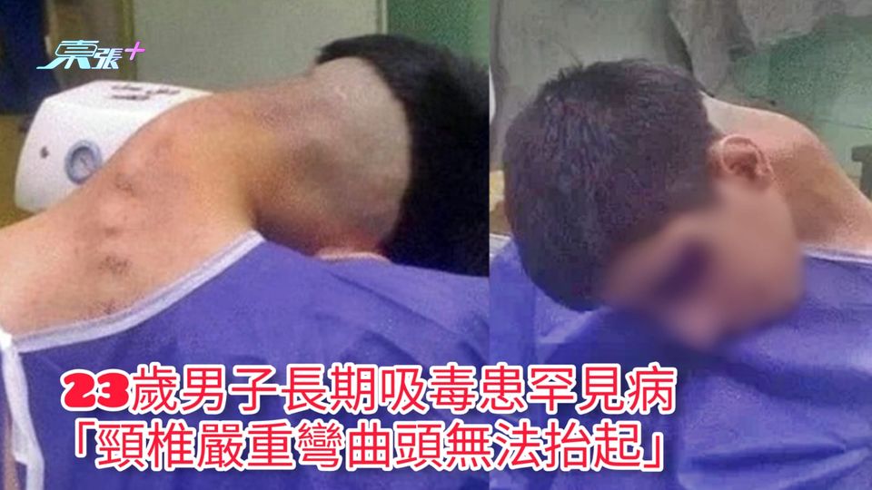23歲男子長期吸毒患罕見病 「頸椎嚴重彎曲頭無法抬起」