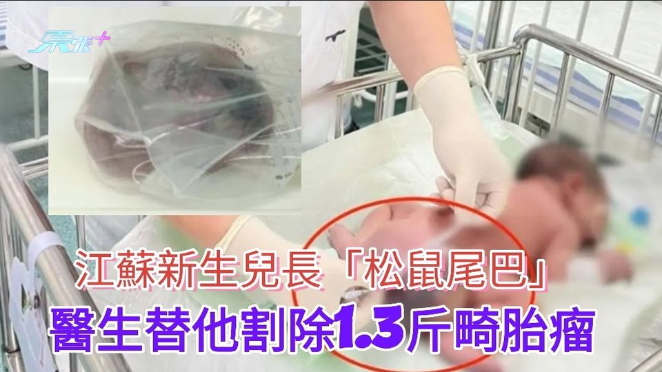 江蘇新生兒長「松鼠尾巴」 醫生替他割除1.3斤畸胎瘤