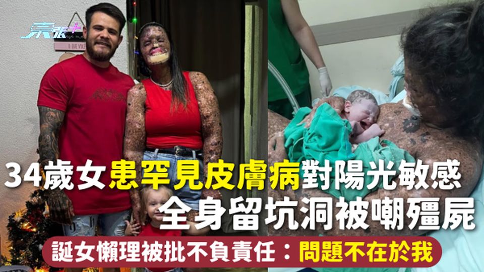 罕見病 | 34歲女患罕見皮膚病對陽光敏感 全身留坑洞被嘲殭屍 誕女懶理被批不負責任：問題不在於我