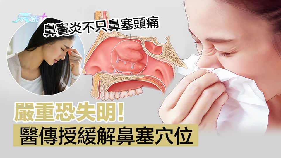 鼻竇炎不只鼻塞頭痛 嚴重恐失明！醫傳授緩解鼻塞穴位