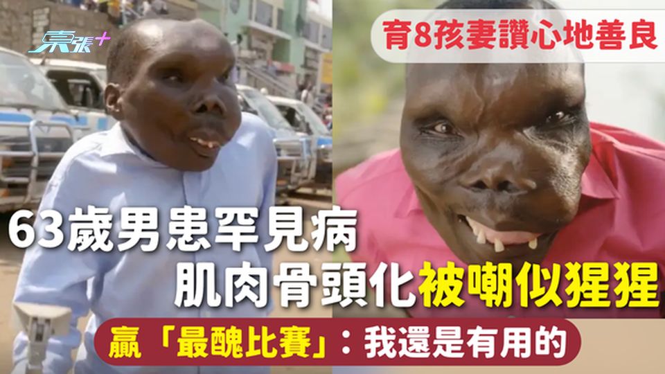 罕見病｜63歲男患罕見病肌肉骨頭化 被嘲似猩猩贏「最醜比賽」：我還是有用的 育8孩妻讚心地善良