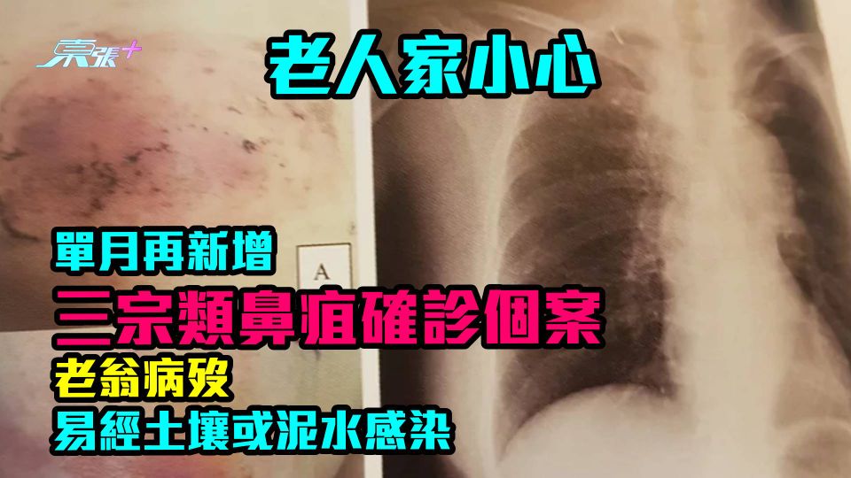 老人家小心｜單月再新增三宗類鼻疽確診個案 一人病歿　易經土壤或泥水感染