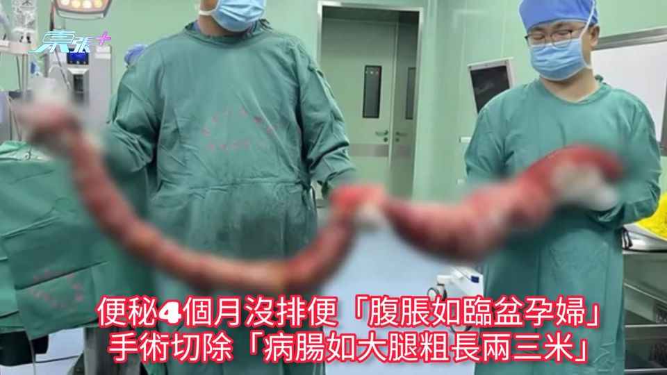 便秘4個月沒排便「腹脹如臨盆孕婦」 手術切除「病腸如大腿粗長兩三米」