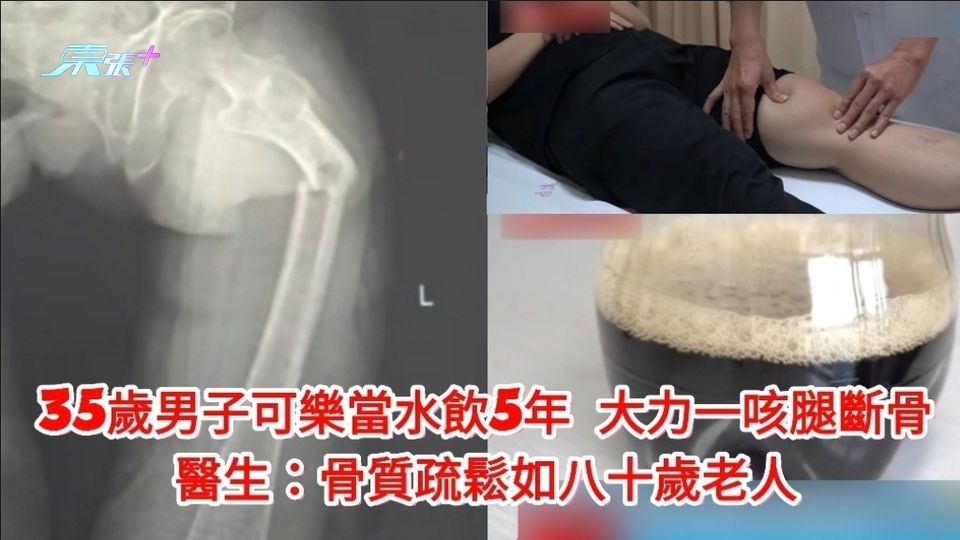 有片|男子可樂當水飲5年 大力一咳腿斷骨 醫生:骨質疏鬆如80歲老人