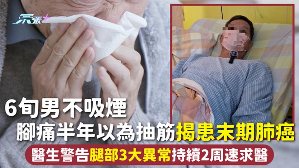肺癌 | 6旬男不吸煙 腳痛半年以為抽筋揭患末期肺癌 醫生警告腿部3大異常持續2周速求醫