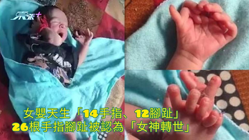 女嬰天生「14手指、12腳趾」 26根手指腳趾被認為「女神轉世」