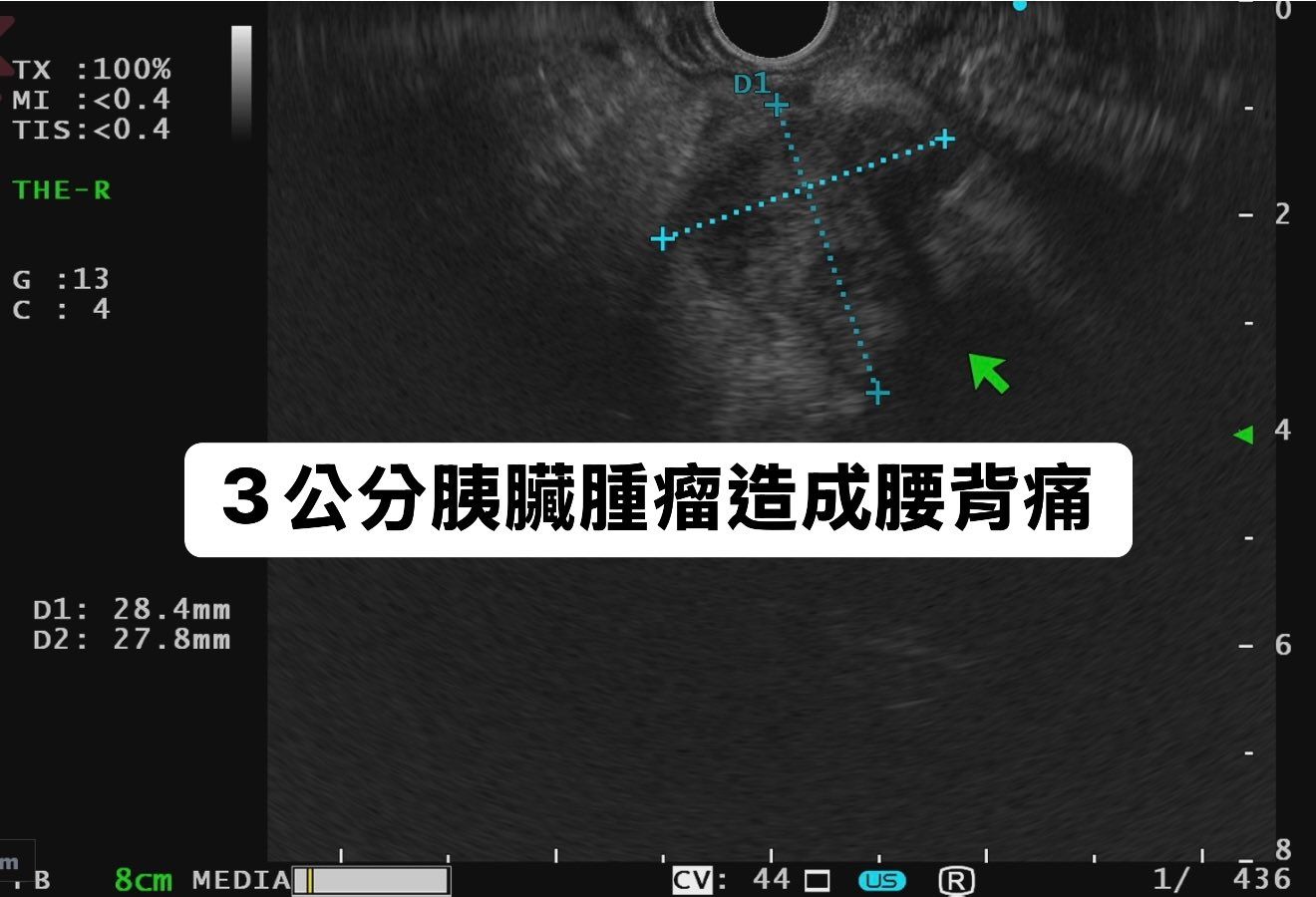 可能是 X 光和顯示的文字是「 TX :100% MI :<0.4 TIS: TIS:<0.4 4 THE-R THE R G G:13 :13 c C:4 4 D1: 28 28.4mm D1:28.4mm 4mm D2: 27 27.8mm 8mm 3公分膜臟腫瘤造成腰背痛 B 8cm MEDIA 'CV: 44 US R 8 436 」的圖像