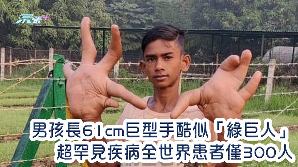 男孩長61cm巨型手酷似「綠巨人」 超罕見疾病全世界患者僅300人