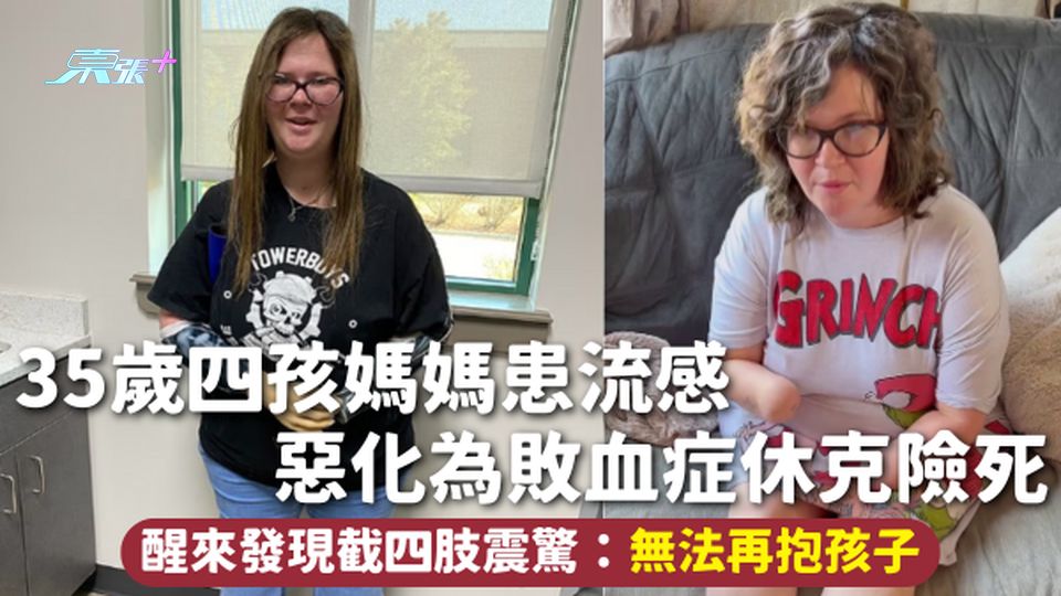 流感 | 35歲四孩媽媽患流感 惡化為敗血症休克險死 醒來發現截四肢震驚：無法再抱孩子