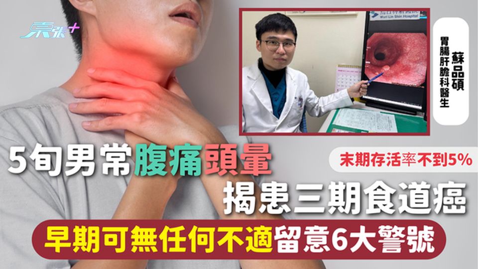 食道癌 | 5旬男常腹痛頭暈 揭患三期食道癌 早期可無任何不適 末期存活率不到5％ 留意6大警號
