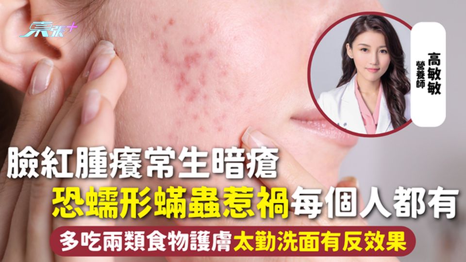 臉部皮膚 | 臉紅腫癢常生暗瘡 恐蠕形蟎蟲惹禍每個人都有 多吃兩類食物護膚 太勤洗面有反效果