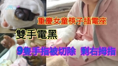 重慶女童不銹鋼筷子插電座致雙手電黑 9隻手指被切除 剩右拇指