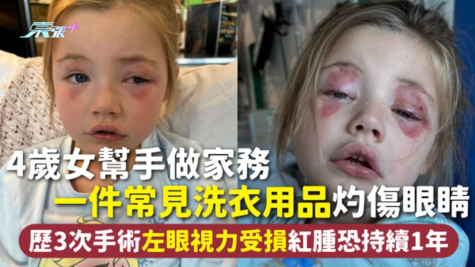 家長注意 | 4歲女幫手做家務 一件常見洗衣用品灼傷眼睛 歷3次手術左眼視力受損 紅腫恐持續1年