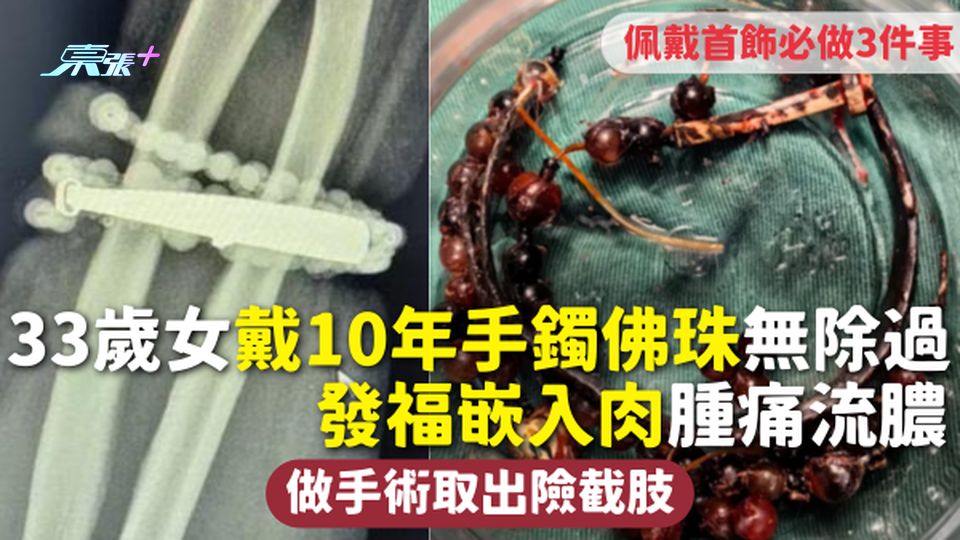 33歲女戴10年手鐲佛珠無除過 發福嵌入肉腫痛流膿 做手術取出險截肢 佩戴首飾必做3件事