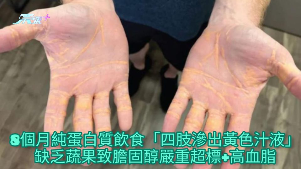 8個月純蛋白質飲食「四肢滲出黃色汁液」 缺乏蔬果致膽固醇嚴重超標&高血脂