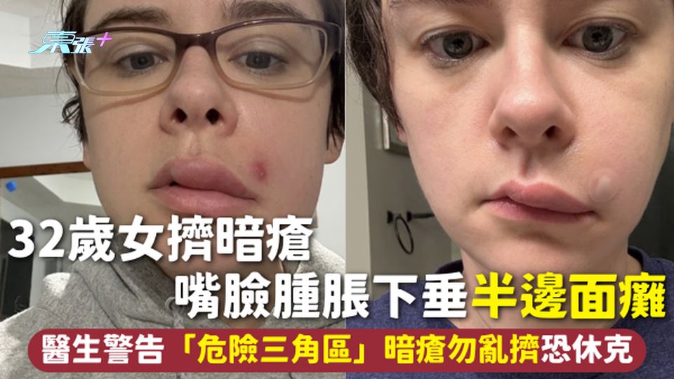 擠暗瘡 | 32歲女擠暗瘡 嘴臉腫脹下垂半邊面癱 醫生警告「危險三角區」暗瘡勿亂擠恐休克
