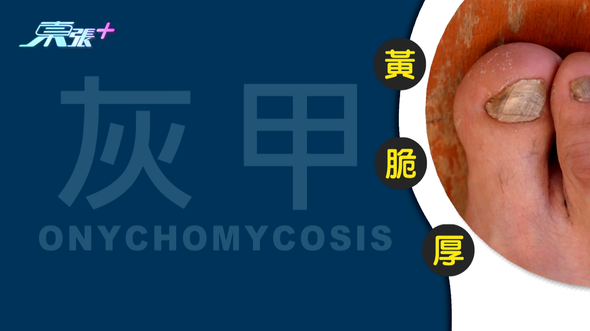 指甲變黃、變脆、變厚？以為很少事，其實你好可能已經患上灰甲了。因為灰甲不止會傳染，而且「愈耐愈難醫」，真的聽見都怕怕， 染上就更擔心！