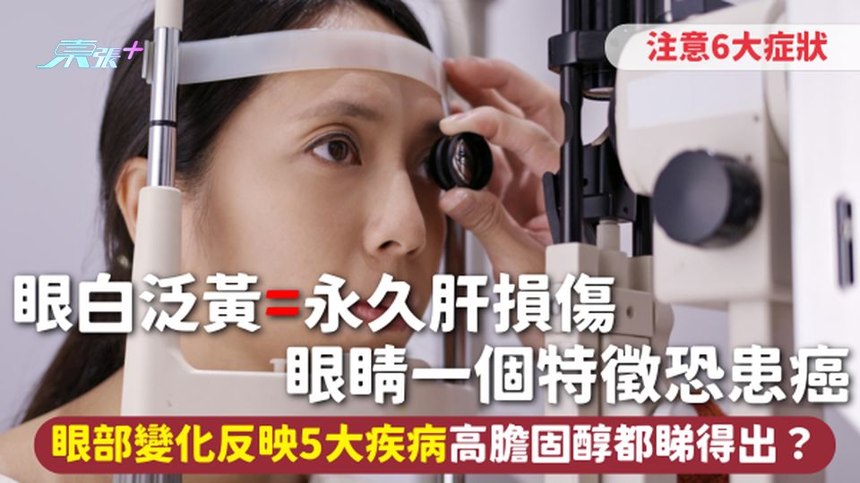 眼白泛黃=永久肝損傷 眼睛一個特徵恐患癌 眼部變化反映5大疾病 高膽固醇都睇得出？注意6大症狀