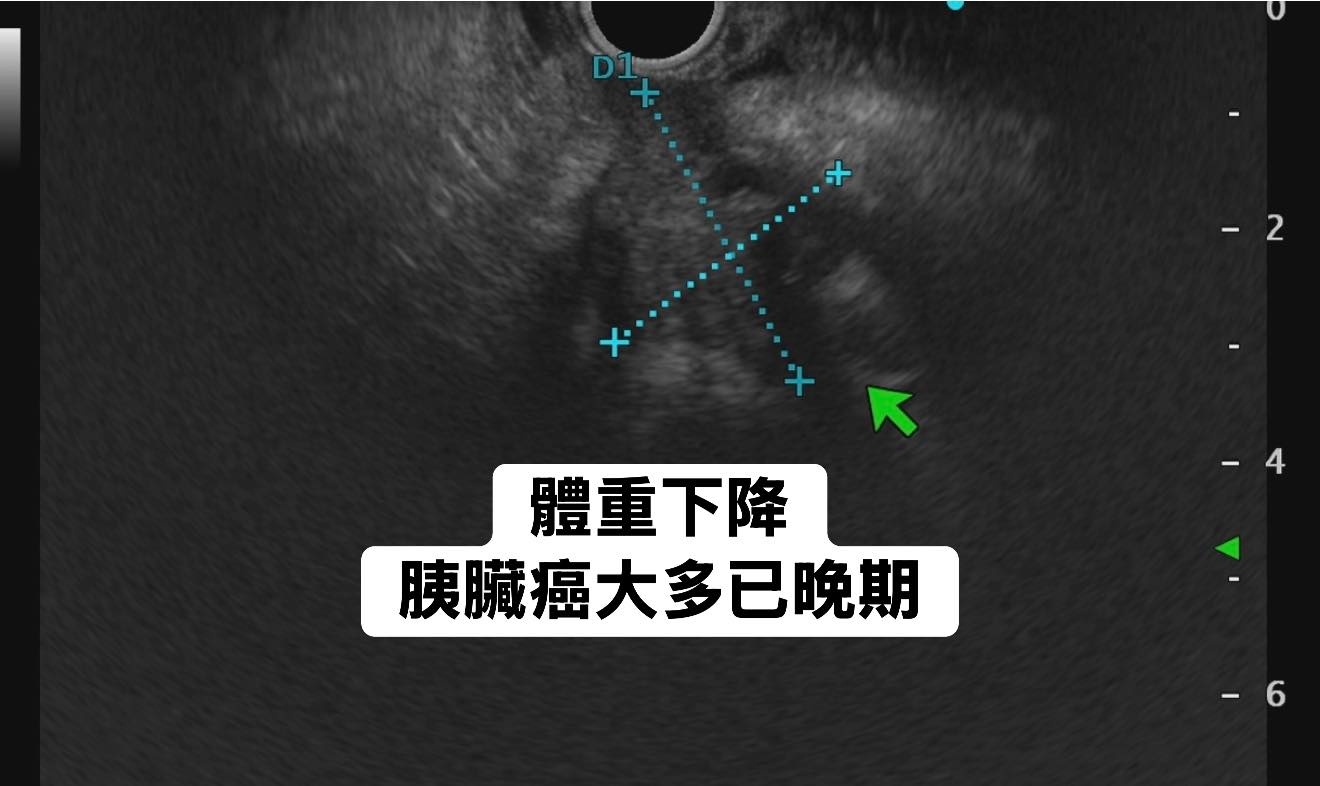 May be an image of xray and text that says 'D1 + -2 體重下降 胰臟癌大多已晚期 -6'