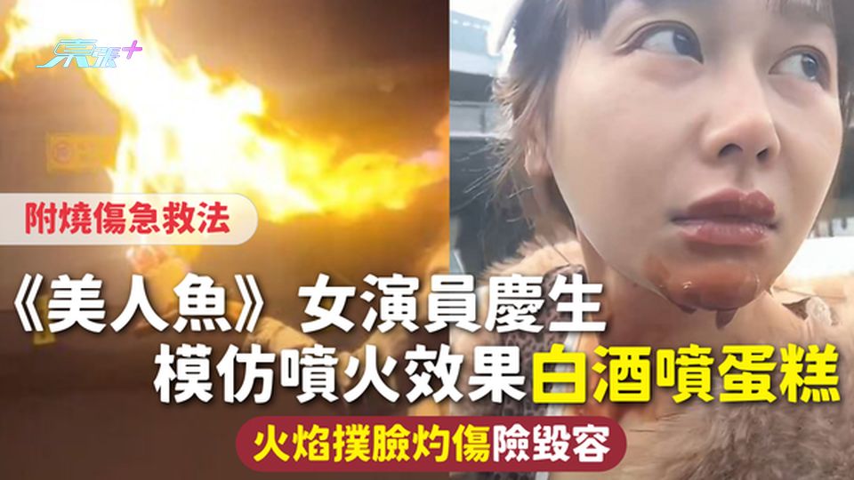 燒傷意外 | 《美人魚》女演員慶生 模仿噴火效果白酒噴蛋糕 火焰撲臉灼傷險毀容 附燒傷急救法