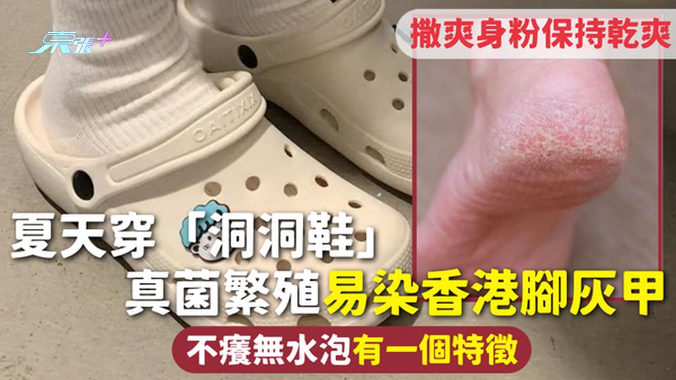 香港腳 | 夏天穿「洞洞鞋」 真菌繁殖易染腳癬灰甲 不癢無水泡有一個特徵 撒爽身粉保持乾爽