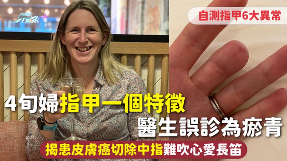 皮膚癌 | 4旬婦指甲一個特徵 醫生誤診為瘀青 揭患皮膚癌切除中指難吹心愛長笛 自測指甲6大異常