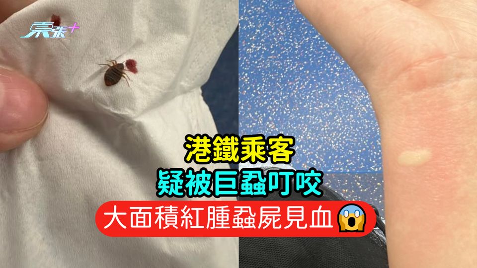 港鐵乘客疑被巨蝨叮咬  大面積紅腫蝨屍見血