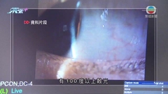 中大醫學院發現本港兒童散光比率較海外城市高 遺傳屬最大風險因素