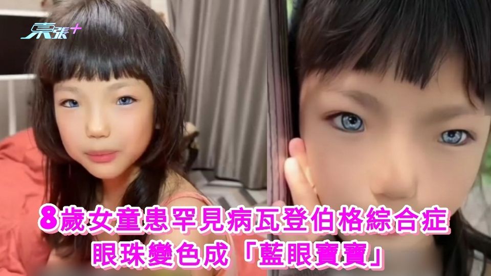有片丨8歲女童患罕見病瓦登伯格綜合症 眼珠變色眼珠變色成「藍眼寶寶」
