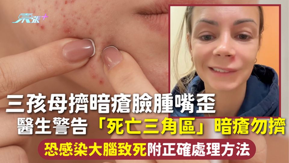 暗瘡 | 三孩母擠暗瘡臉腫嘴歪 醫生警告「死亡三角區」暗瘡勿擠 恐感染大腦致死 附正確處理方法