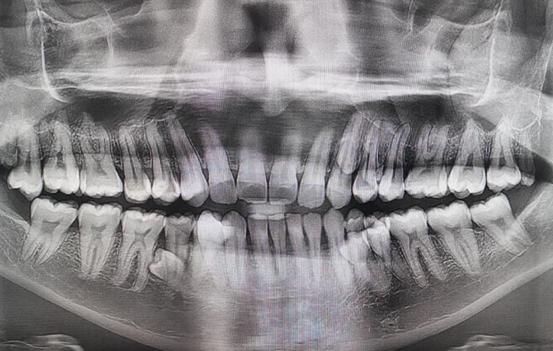 大馬男子生「42隻牙」刷新世界紀錄　X光照曝光無P圖震驚大眾