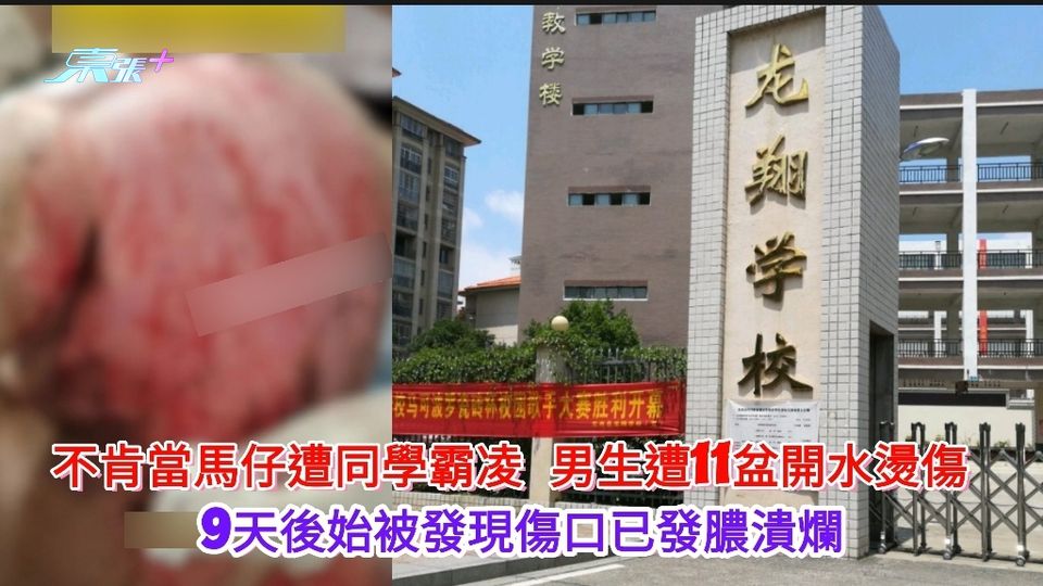 有片｜不肯當馬仔遭同學霸凌 男生遭11盆開水燙傷 被發現時傷口已潰爛