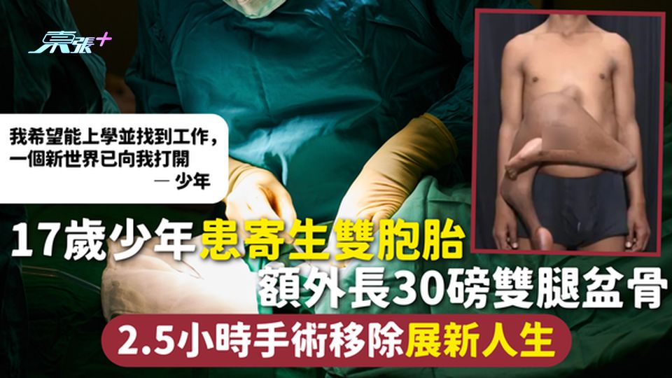 罕見病 | 17歲少年患寄生雙胞胎被孤立輟學 額外長30磅雙腿盆骨 2.5小時手術移除展新人生