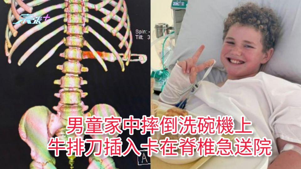 男童家中摔倒洗碗機上 牛排刀插入卡在脊椎急送院
