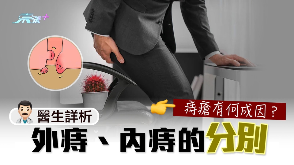 痔瘡有何成因？醫生詳析外痔、內痔的分別