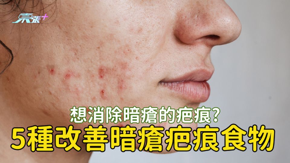暗瘡後留疤？五種改善暗瘡疤痕的食物🍉 #至識健康