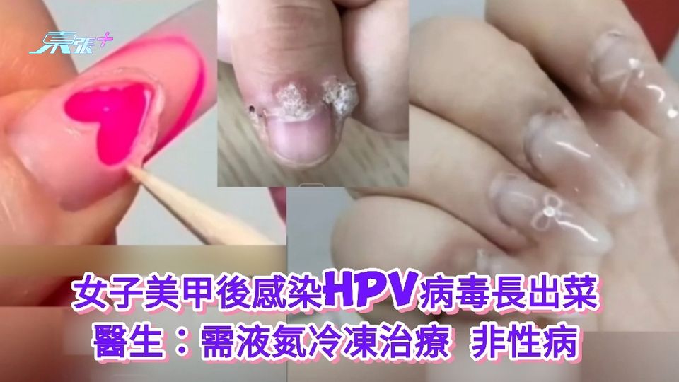 有片|女子美甲後感染HPV病毒長出菜花 醫生：需液氮冷凍治療 非性病