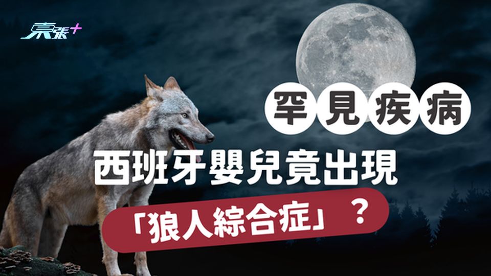 【驚現狼人寶寶？】西班牙嬰兒竟出現「狼人綜合症」！一文即睇原因