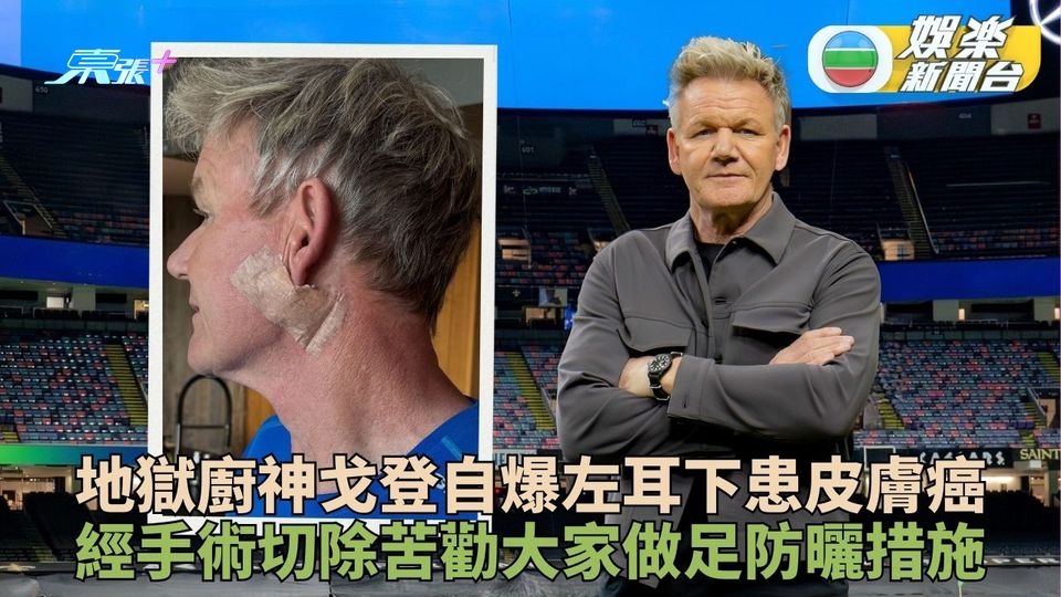地獄廚神戈登去年遇意外險死 今突揭患皮膚癌已切除腫瘤
