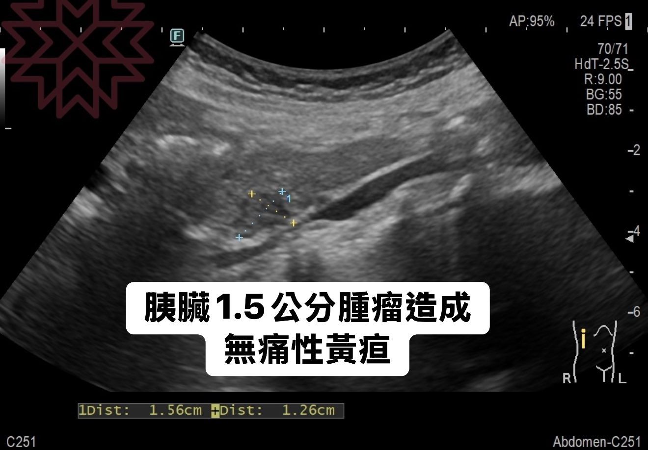 可能是 X 光和顯示的文字是「 F AP:95% 24FPS1 24 FPS 70/71 71 70 HdT-2.5S_ -2. 5S_ R:9.00 BG:55 BG :55 BD:85- 85 BD: -2 膜臟1.5公分腫瘤造成 胰膩 無痛性黃疤 C251 LDist:1.56cmHpist:1.26cm 1.56cm +Dist: 1Dist: 1.26cm R Abdomen-C251 」的圖像
