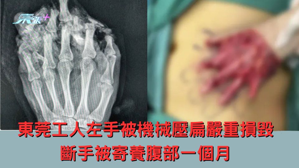 東莞工人左手被機械壓扁嚴重損毀 斷手被寄養腹部一個月