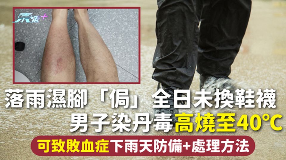 腳部感染 | 落雨濕腳「侷」全日未換鞋襪 男子染丹毒高燒至40℃ 可致敗血症下雨天防備+處理方法