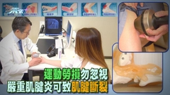 運動勞損勿忽視 嚴重肌腱炎可致肌腱斷裂