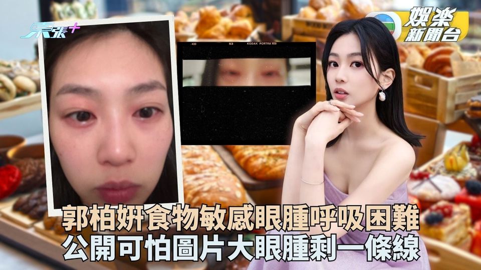 靚女郭柏姸慘遇食物敏感 大眼腫剩一條線全面呼吸困難